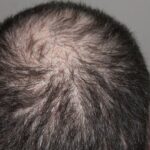 Alopecia